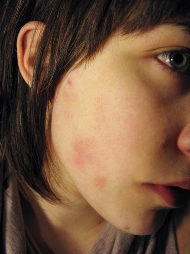 pimples all around eczema
