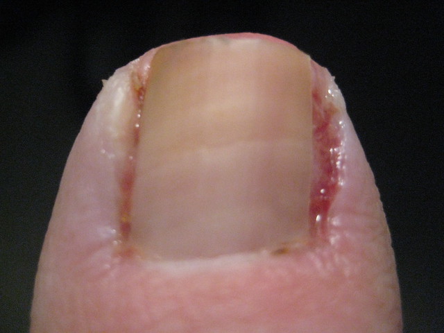 day-4-post-ingrown-toenail-removal-surgery-flickr-photo-sharing