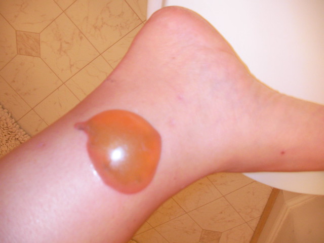 Tattoo Removal 1st Treatment Day 7 - huge blister