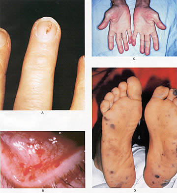 Congenital syphilis: MedlinePlus Medical Encyclopedia