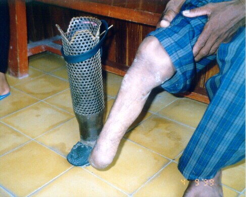 A home-made prosthetic limb