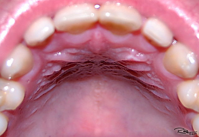 Roof Of Mouth Is Raw 121