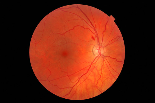 Retinal Haemorrhage