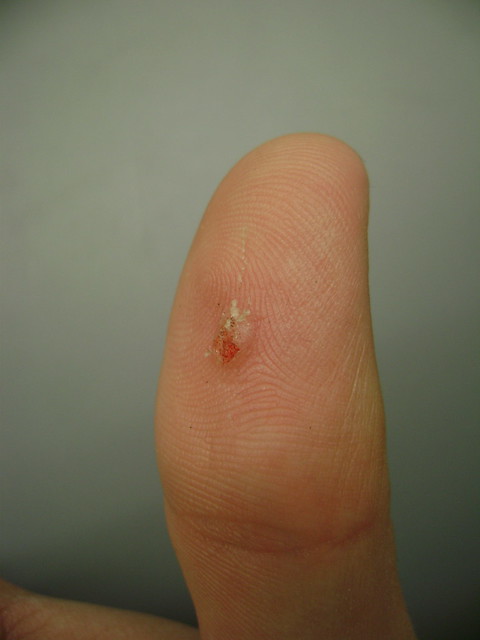 Warts (Common Warts) Symptoms, Treatment, Causes - What if ...