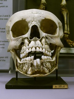 Child's skull with baby teeth and adult teeth, Hunterian Museum, London