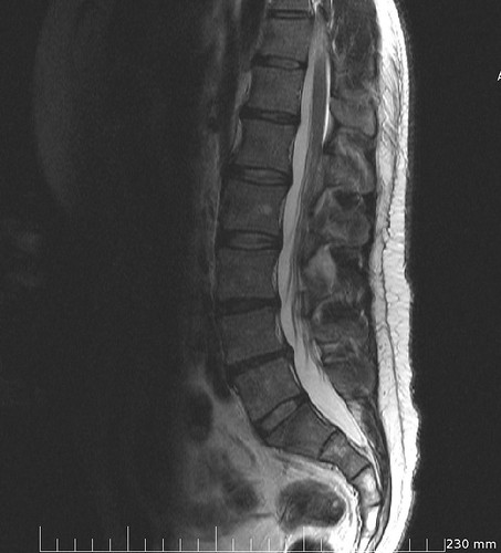 My screwy back, MRI, London, UK