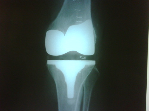 Journey knee replacement AP view x-ray .