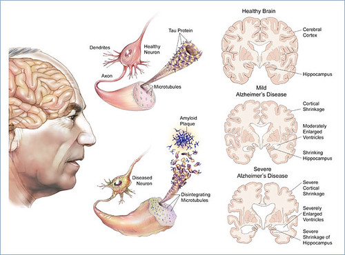 stages of alzheimers disease