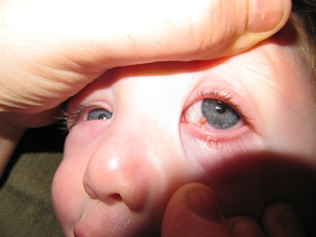 mysterious-bump-on-seth-s-eyeball-conjuctival-cyst-flickr-photo