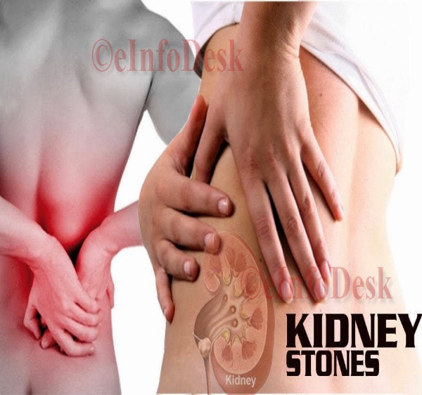Kidney Stones Introduction