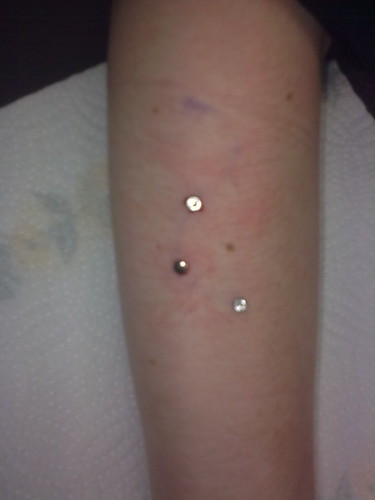 This is the first phase of my bionic arm I'm having a series of dermal 