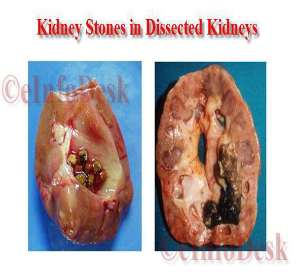 Stones found in Real Dissected Kidneys