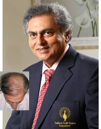 No age matter for hair transplant by aimalchud