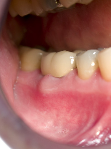 gingival abscess