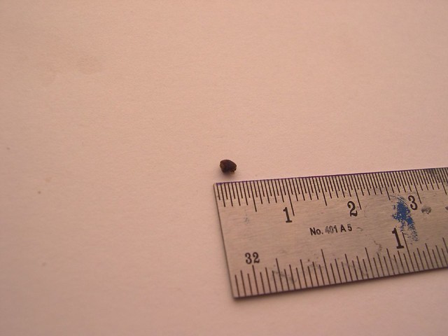 2mm-kidney-stone-flickr-photo-sharing