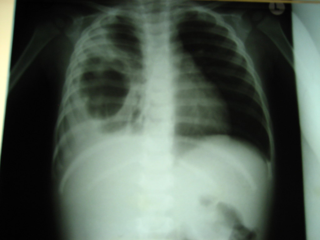 Фото рентгена легких при коронавирусе фото