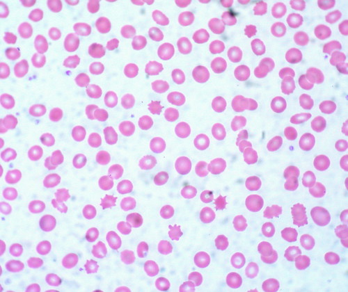 Acanthocytes, Peripheral Blood