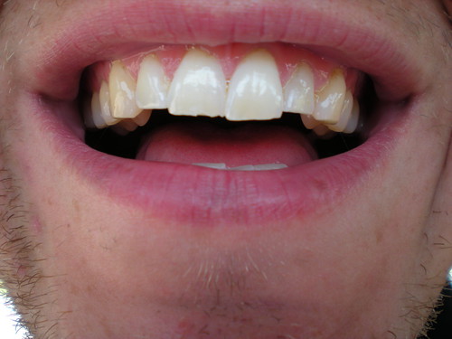 chipped tooth