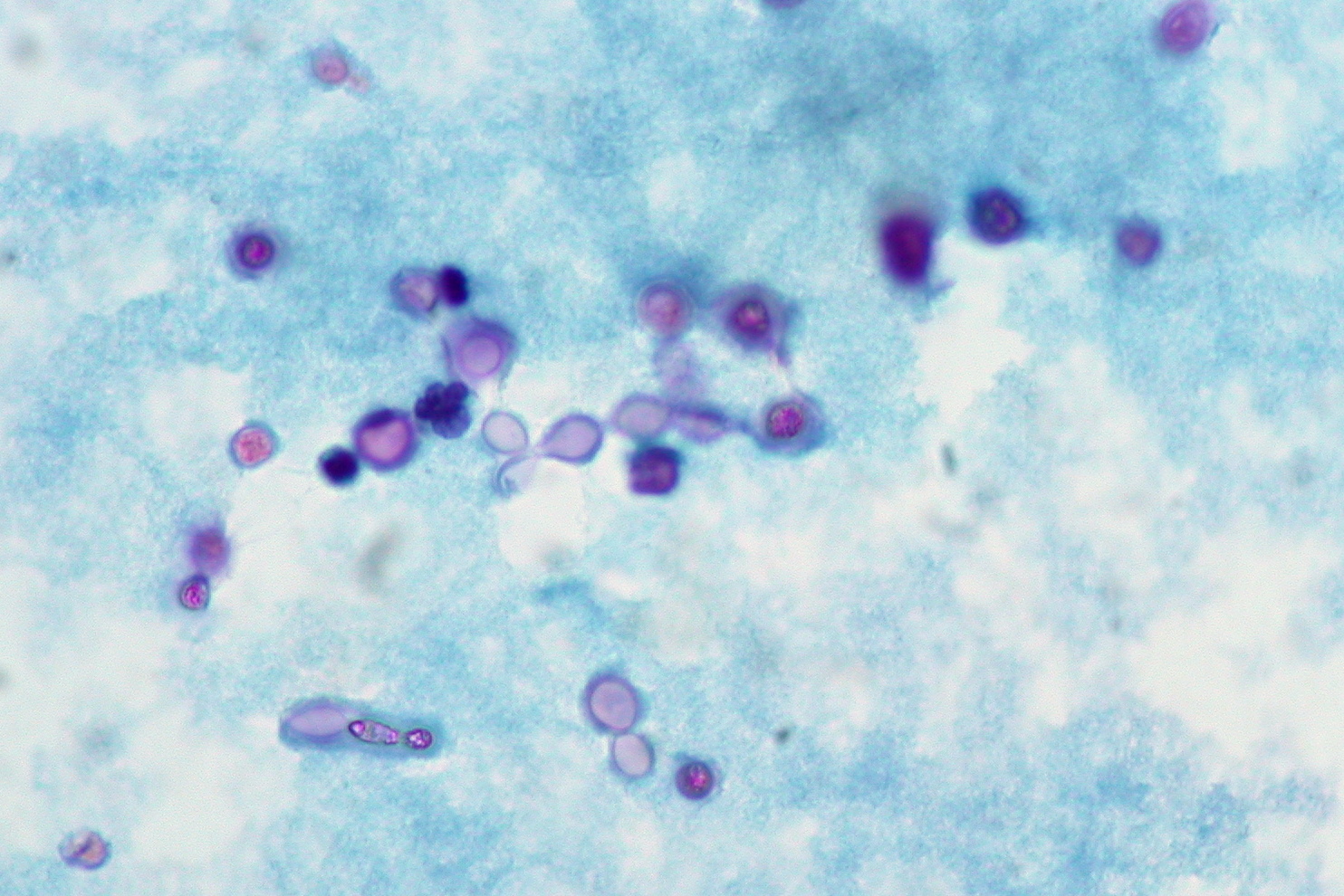 Meningeal Cryptococcosis, CSF, Pap stain | AIDS patient ...