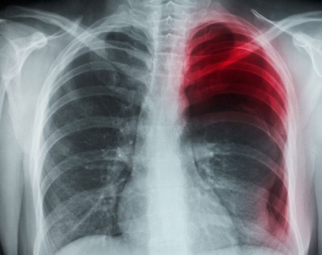 radiografía pulmón