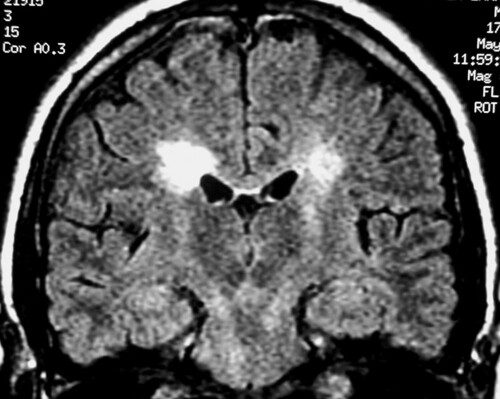 An MRI of an MS brain. MRI in a patient with multiple sclerosis demonstrates periventricular high–signal intensity lesions, which exhibit a typical distribution for multiple sclerosis. Via http://emedicine.medscape.com/article/342254-overview