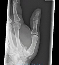 thumb arthritis xray - hyperpronated view | Flickr - Photo Sharing!