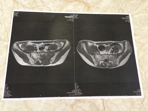悪性リンパ腫のMRI画像（仙骨部）。左が治療前、右が抗がん剤治療1コース（Hyper-CVAD療法）終了後。