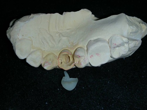 台中豐美牙醫診所 3D全瓷冠齒雕分享 (2)