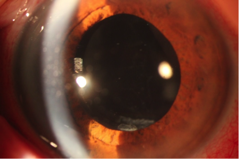 Aspecto del ojo tras la realización de la capsulotomía con láser Yag.